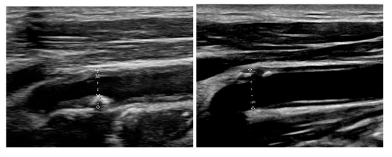 逆轉血管風險!長期高強度降血脂治療 新竹臺大醫助頭頸癌病人改善頸動脈斑塊 逆轉血管風險!長期高強度降血脂治療 新竹臺大醫助頭頸癌病人改善頸動脈斑塊