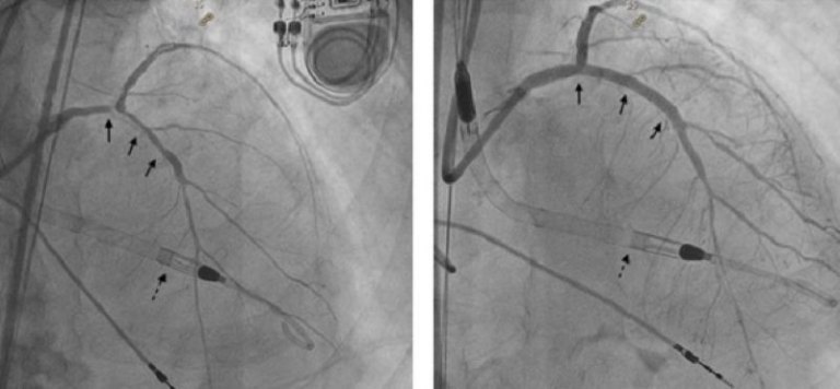 新竹臺大分院Impella微型心室輔助裝置協助高風險冠狀動脈介入治療　成功救治 88 歲心肌梗塞病人