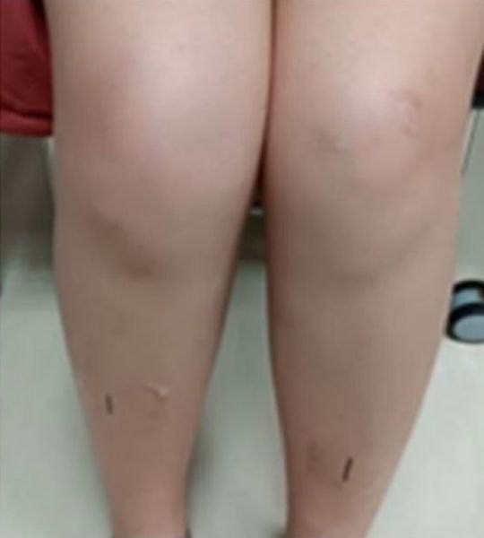 年輕女性騎飛輪後茶色尿　新竹臺大分院提醒當心急性橫紋肌溶解症