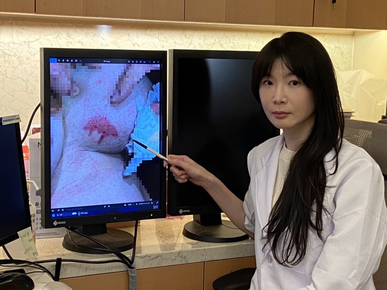 暖暖包貼乳房9小時釀灼傷 醫師示警低溫燙傷與「火逼性紅斑」風險 暖暖包貼乳房9小時釀灼傷 醫師示警低溫燙傷與「火逼性紅斑」風險