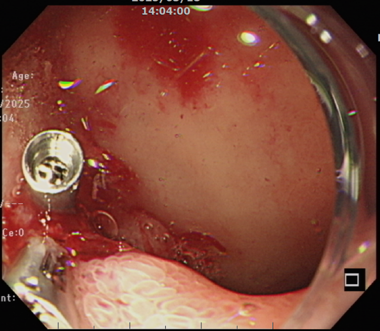 急性消化道出血嚴重時可能造成休克甚至危及生命　蔡志奇主任：快速、有效的止血至關重要