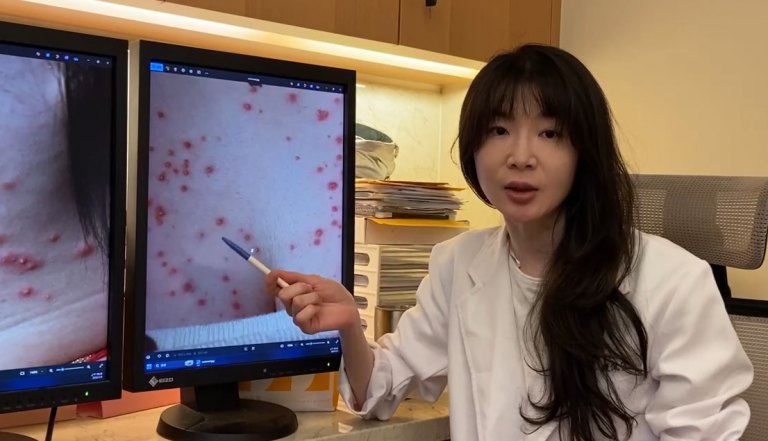 濕疹誤擦類固醇釀「紅豆胸紅痘脖」　醫師：過度使用恐傷全身