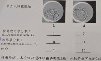 子宮內膜癌不等於生育終點　台中婦治療後把握黃金期1年順利產子