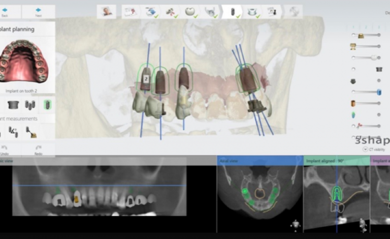 數位牙科助攻植牙治療　醫師：完整評估與假牙設計是關鍵
