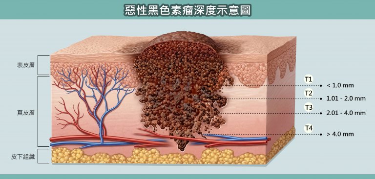 誤當甲溝炎險喪命　高醫跨團隊揪出致命黑色素瘤