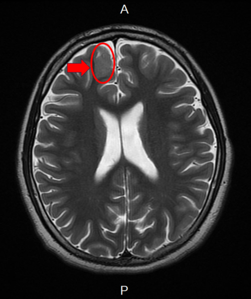 14歲少年癲癇規律服藥仍頻繁發作　醫提醒可能與腦皮質發育不良有關