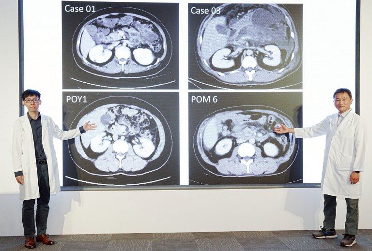 中醫大附醫多專科團隊合力逆轉壞死性胰臟炎　大幅提升存活率