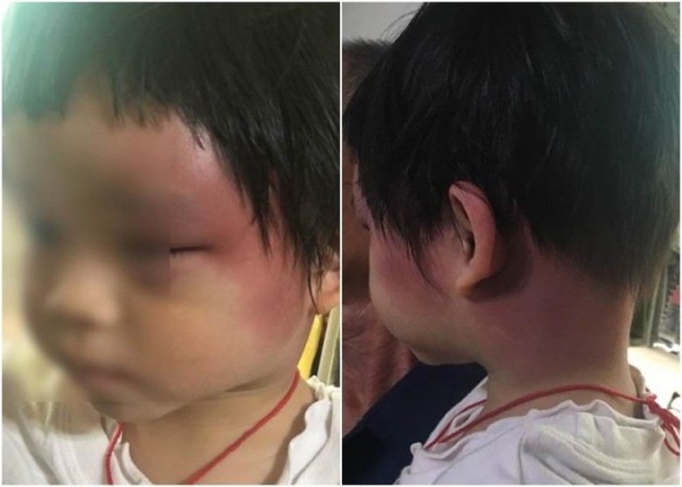 ▲ 3歲曾小妺妺左臉嚴重紅腫淤傷，左眼幾乎睜不開。(圖片來源／網路)